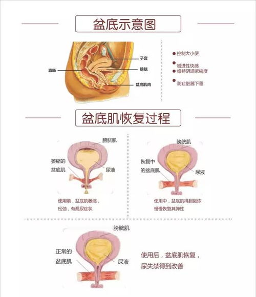 产后盆底肌肉训练对压力性尿失禁的影响的技术报告