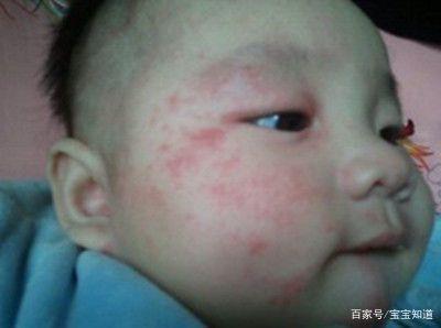怎样预防婴儿长湿疹