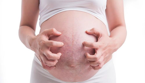 怀孕期如何防止妊娠纹长出来