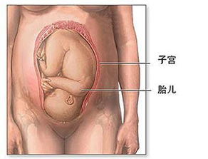 刨腹产如何快速恢复子宫