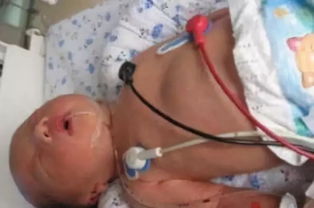 婴幼儿窒息的临床表现