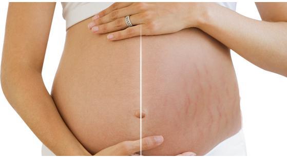 孕妇怎么防止妊娠纹