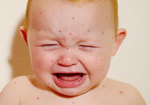 预防婴儿湿疹的方法