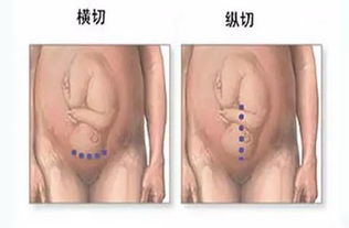 剖腹产后刀口护理——五步指南