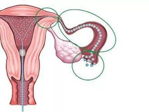 输卵管通畅度的检查方法