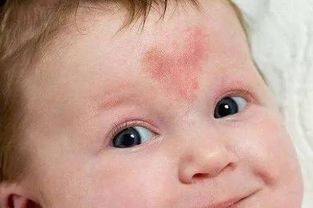 怎么预防新生儿脸上有胎记呢