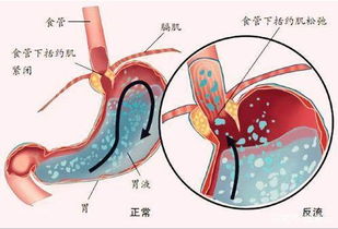 如何预防早产儿胃食管反流