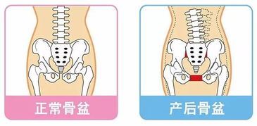 产后骨盆肌修复怎么做