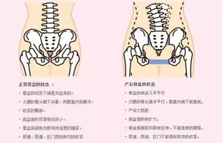 产后修复骨盆修复怎么做的