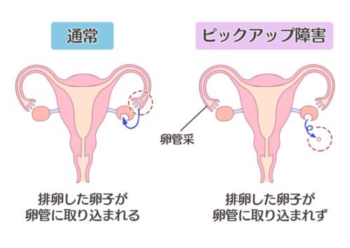 不孕不育症原因分析