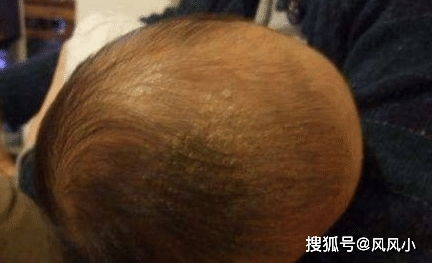 新生宝宝头皮怎么去掉