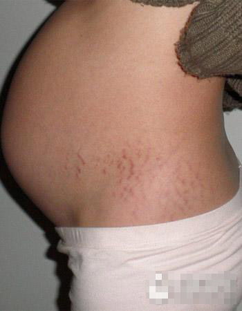 怀孕期如何防止妊娠纹