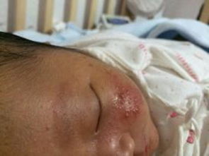 新生儿皮肤常见问题及处理